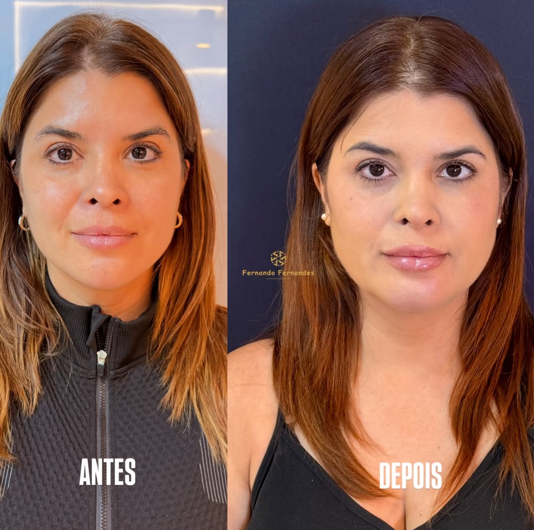 Resultado Harmonização Facial — Antes e Depois